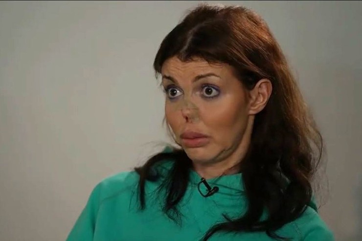 Истощенная сифилисом Алиса Аршавина на грани: «Мама, я жива! У меня есть волосы и нос!»