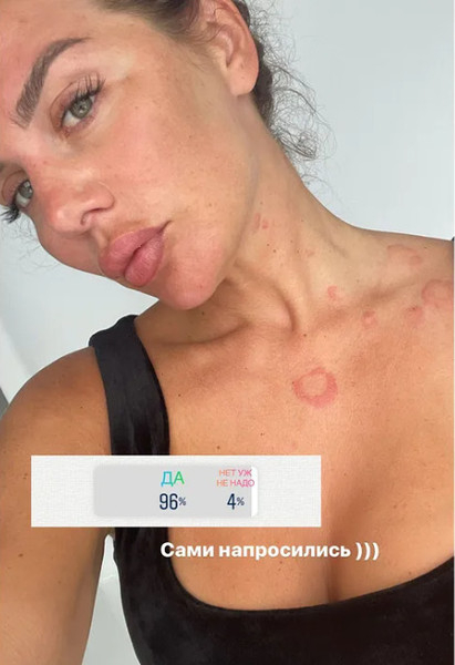Анна Седокова страдает от обострения крапивницы: «Укол за 1000 долларов сейчас нигде не найти»