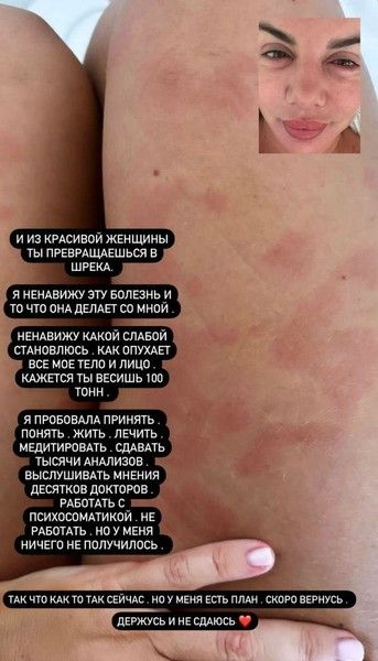 Анна Седокова показала опухшее из-за болезни лицо